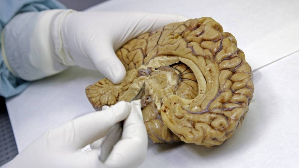Los nuevos fármacos contra el alzhéimer: entre la expectativa y la evidencia